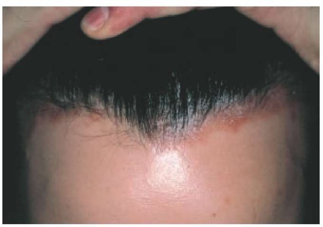 The scalp is affected in the majority of patients with plaque psoriasis. 
