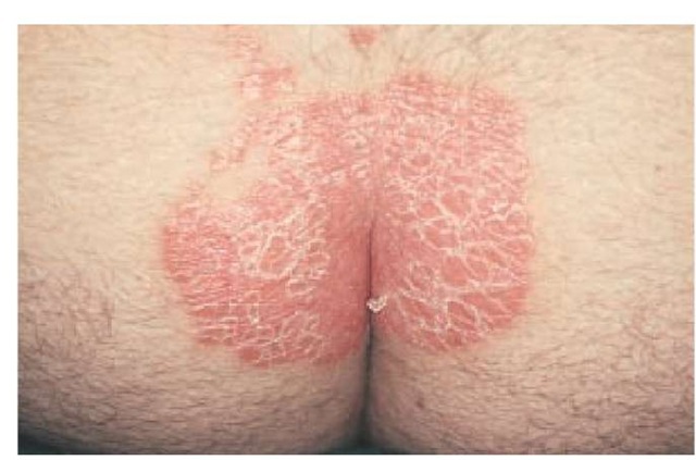  The intergluteal cleft is a common site of involvement in patients with plaque psoriasis. 