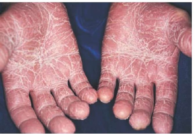 Psoriasis of the palms is shown in this patient. 