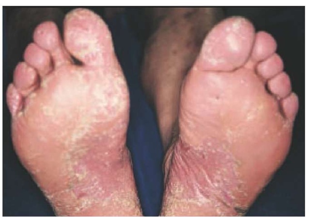 Sharply demarcated, erythematous, scaling plaques on the feet are apparent in this patient with psoriasis of the soles. 