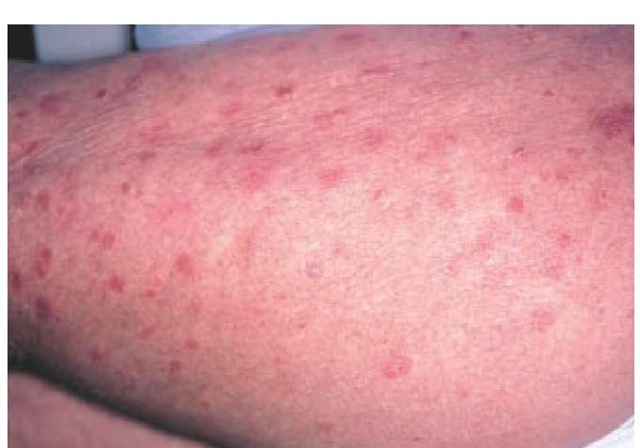 Guttate psoriasis is characterized by small scaly papules and plaques. 