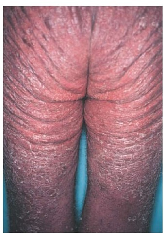 Erythrodermic psoriasis is characterized by generalized erythema and desquamation. 