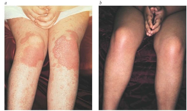 Psoriasis in a child before (a) and after (b) phototherapy. 