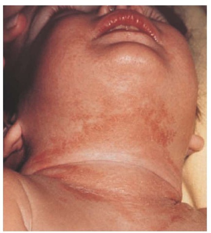 Wearing a plastic bib resulted in irritant dermatitis in an 18-month-old child. 