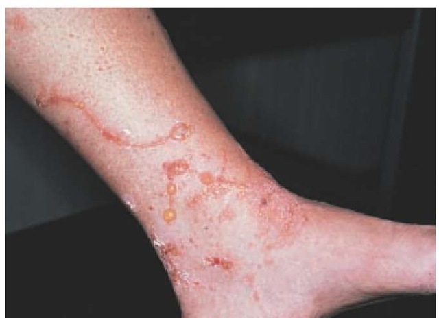  Exposure to poison oak produced this acute Toxicodendron dermatitis with erythema, edema, and linear vesicles and bullae. 