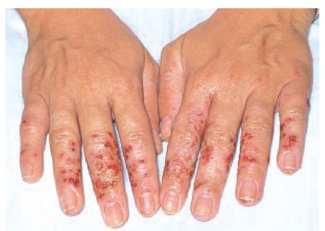 dermatitis hands #10