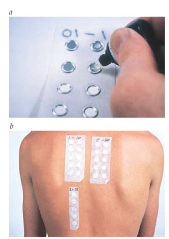 Patch-test allergens to be tested, usually in petrolatum and occasionally aqueous, are placed on Finn Chambers on Scanpor tape (a) for application to the patient's back (b) for 48 hours. See patch testing in text and Figure 7c for a positive patch test. 