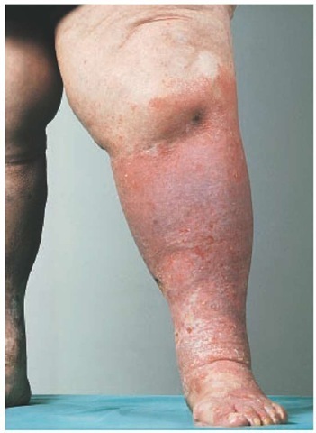 Patients with stasis dermatitis are at high risk for allergic contact dermatitis, especially from topical medications. Bacitracin was the cause in this case. 