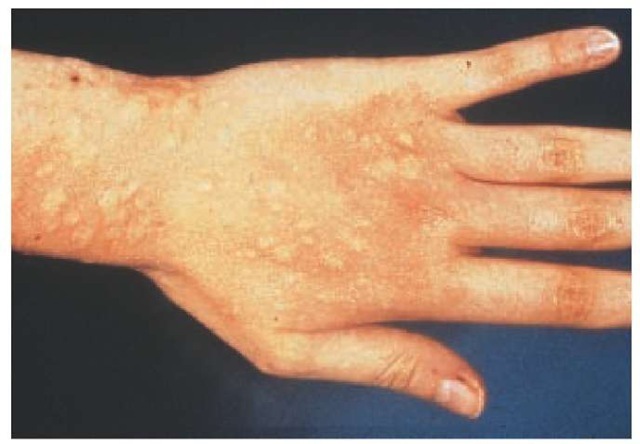 Symptoms of a latex allergy