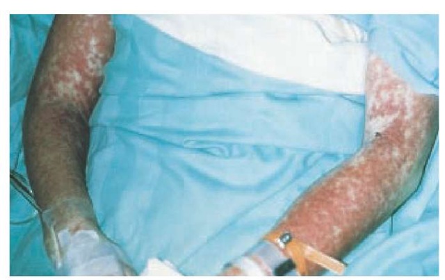 This 35-year-old woman developed hypersensitivity syndrome reaction, characterized by fever, rash, and hepatitis, 14 days after starting trimethoprim-sulfamethoxazole therapy. The rash is an extensive, symmetrical, red edematous eruption.