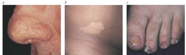 Several of the characteristic cutaneous findings of tuberous sclerosis are shown: adenoma sebaceum (a); ash-leaf macule (b); and periungual fibromas (c). 