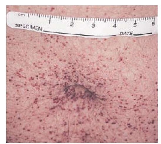 Angiokeratomas are particularly common in the periumbilical area of patients with Fabry disease. 