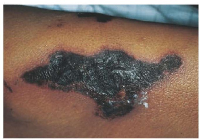 Calcification of arteries in patients with renal failure results in calciphylaxis. Affected skin forms a black, necrotic eschar. 