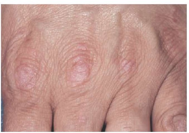 Erythematous scaling papules on the dorsal aspects of the knuckles (Gottron papules) are a sign of dermatomyositis. 