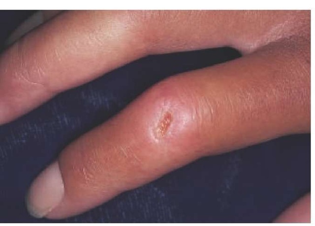 Sclerodactyly with a nonhealing digital ulcer commonly occurs in progressive systemic sclerosis. 