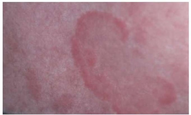  Annular scaling erythematous patches are characteristic of subacute cutaneous lupus erythematosus.