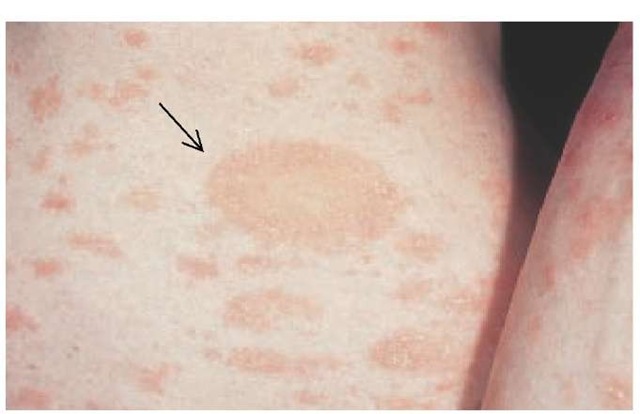 Pityriasis rosea commonly presents as a single, large salmon-colored plaque called a herald patch (arrow). Appearance of the isolated lesion is followed in a week to 10 days by a bilaterally symmetrical papulosquamous eruption, mainly on the trunk and upper extremities. 