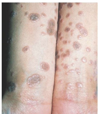 Violaceous, flat-topped, polygonal papules are typical of lichen planus. A common location is the flexor aspect of the wrists and forearms.