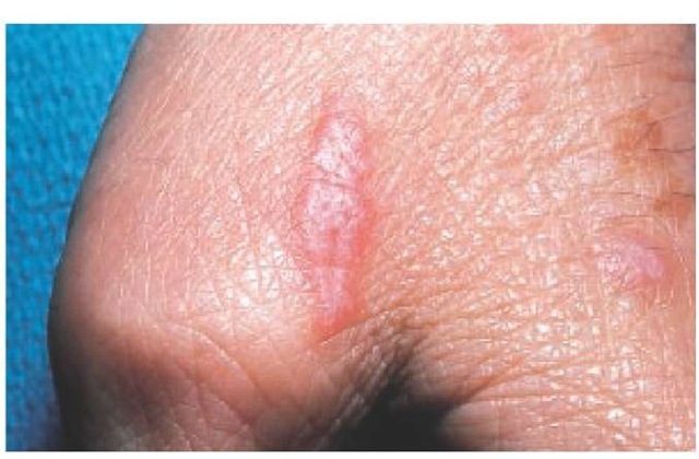 The Koebner phenomenon—the appearance of lesions along a scratch line—may be seen in patients with lichen planus. 