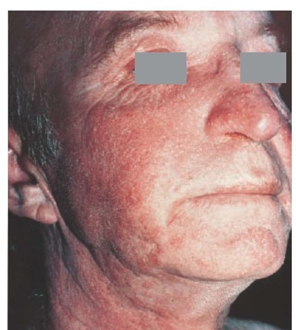 Seborrheic dermatitis seen on the face of this patient involves sites of sebaceous gland activity.  