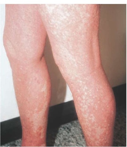  Islands of spared skin within a background of diffuse erythema are present on the legs of this patient with pityriasis rubra pilaris. 