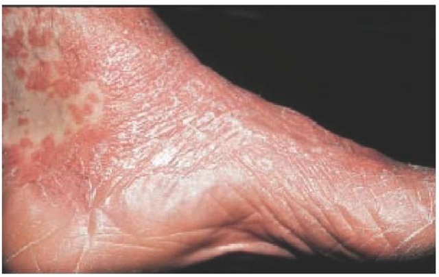 Plantar hyperkeratosis and confluent erythematous follicular papules typical of pityriasis rubra pilaris are seen on the ankle and foot of this patient. 
