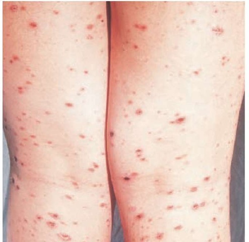 Hemorrhagic brown-crusted varioliform papules are present on the lower legs of this patient with the acute form of pityriasis lichenoides. 