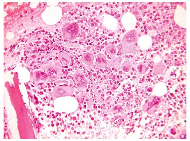  Trephine in essential thrombocythaemia with megakaryocytes clustering with large forms which have abundant mature cytoplasm and deeply lobulated nuclei.