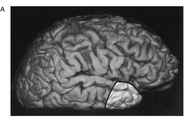 A. Photographs of a fixed brain demonstrating the extent of cortical resection in anterior temporal lobectomy. The lateral neocortical resection extends 3 cm posterior to the tip of the temporal pole in the dominant hemisphere and 4 cm in the nondominant hemisphere. 