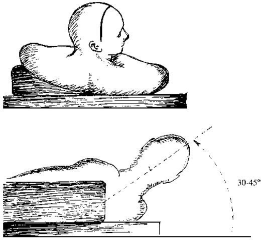 The patient is placed supine and the head is elevated to 30 to 45 degrees. The head is turned to the right so that gravity can help retract the nondominant hemisphere and the microscope can maintain stereoscopic vision. 