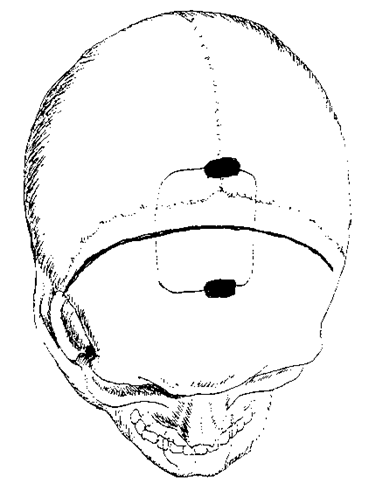A partial bicoronal skin incision is performed and the temporalis muscle is not violated. A burr is used to drill slots over the sinus and a craniotomy is elevated 2/3 in front and 1/3 behind the coronal suture, extending just over the midline. 