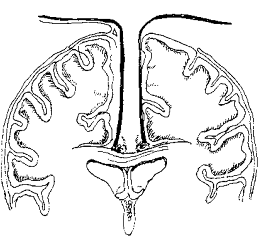Interhemispheric dissection exposes the corpus callosum between the pericallosal arteries. 