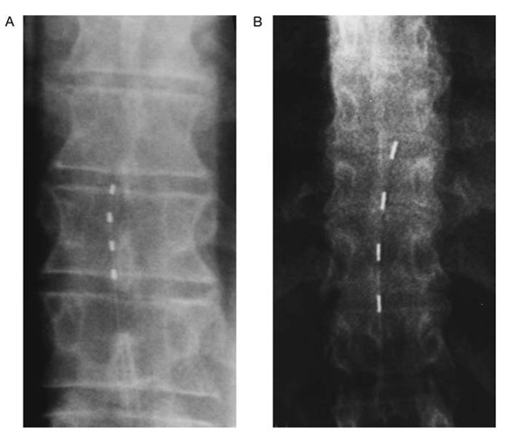 Intraoperative images of percutaneously inserted spinal cord stimulation electrodes. Each electrode has four contacts that may provide stimulation with a variety of configurations, including monopolar and bipolar stimulation modes. A, Pisces-Quad electrode (Medtronic); B, Pisces-Quad Plus (Medtronic).