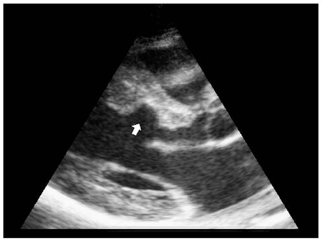 Transthoracic echocardiography, parasternal long axis view with thinning of the basal interventricular septum (arrow) three months following ASA. 