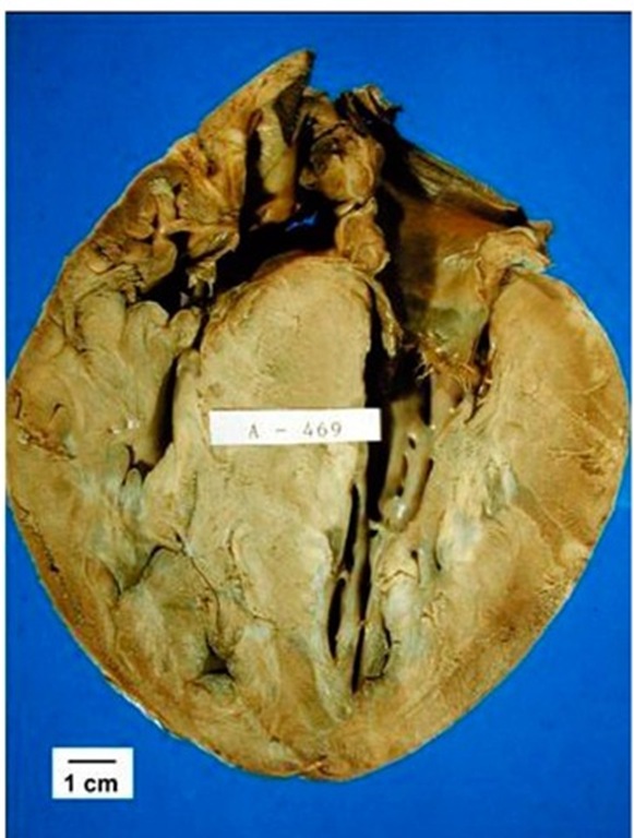 Longitudinal section of the heart of a 9 year-old boy, who died suddenly during ordinary activities, with predominant hypertrophy of the septum but also showing increased thickness of the free wall of both ventricles. During life, obstruction of both the left and right ventricular outflow tracts was present. 