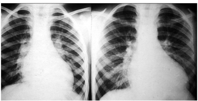 Chest x-rays of a boy at 11 and 13 years of age showing great increase in the heart size coincident with pubertal growth spurt. 
