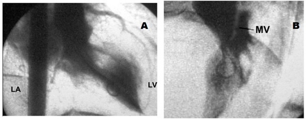 A. Left ventricular cineangiocardiogram in the right anterior oblique projection showing a hypertrophied chamber with subaortic obstruction and moderate mitral insufficiency with left atrial enlargement. B. In the left anterior oblique view the anterior mitral valve can be seen contacting the septum. LV: left ventricle; LA: left atrium; MV: mitral valve. 