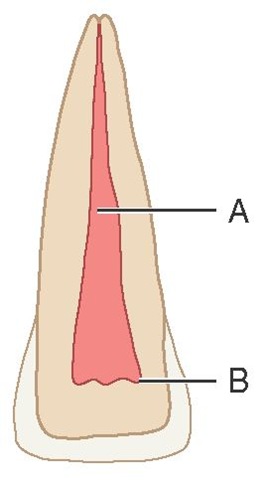 Permanent central incisor. A, Pulp canal; B, pulp horns. This figure represents a sectioned central incisor of a young person. Although the pulp canal is rather large, it is smaller than the pulp canal shown in Figure 3-9, and it becomes more constricted apically. Note the dentin space between the pulp horns and the incisal edge of the crown.
