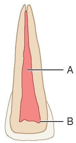 Primary central incisor. A, Pulp canal; B, pulp horns. This figure represents a sectioned primary central incisor. The pulp chamber with its horns and the pulp canal are broader than those found in Figure 3-8. The apical portion of the canal is much less constricted than that of the permanent tooth. Note the narrow dentin space incisally.