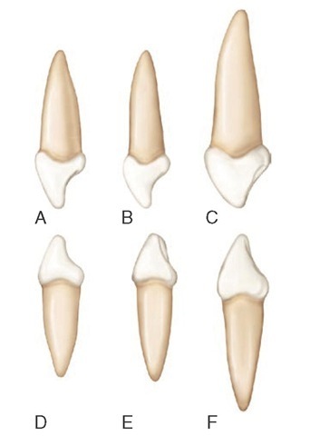 Primary right anterior teeth, mesial aspect. A, Maxillary central incisor. B, Maxillary lateral incisor. C, Maxillary canine. D, Mandibular central incisor. E, Mandibular lateral incisor. F, Mandibular canine.