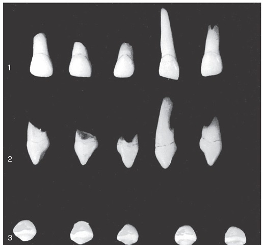 Primary maxillary lateral incisors (second incisors). 1, Labial aspect. 2, Mesial aspect. 3, Incisal aspect.
