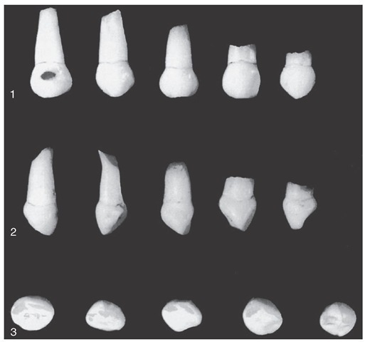 Primary mandibular central incisors. 1, Labial aspect. 2, Mesial aspect. 3, Incisal aspect.