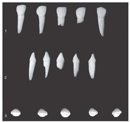 Primary mandibular lateral incisors. 1, Labial aspect. 2, Mesial aspect. 3, Incisal aspect.
