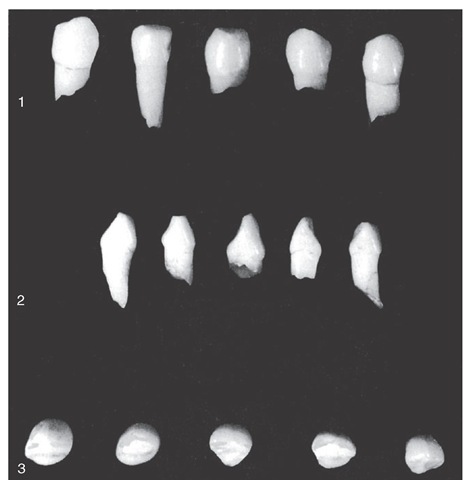 Primary mandibular central incisors. 1, Labial aspect. 2, Mesial aspect. 3, Incisal aspect.