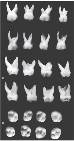 Primary maxillary second molars. 1, Buccal aspect. 2, Mesial aspect. 3, Occlusal aspect.
