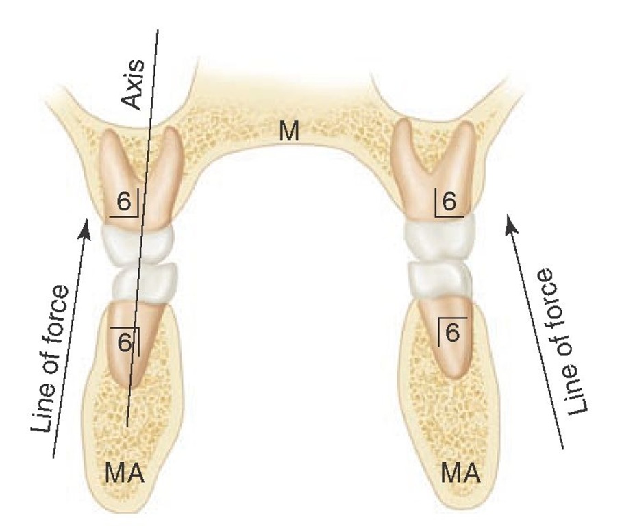 Schematic representation of clinical principle of making restorations and implants consistent with directing lines of forces parallel with long axes of the teeth. M, Maxilla; MA, mandible. Teeth numbered using Zsigmondy/Palmer notation.