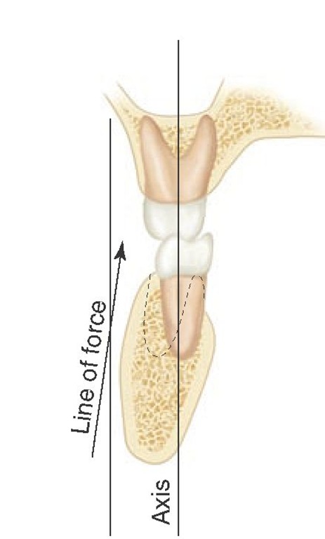 Schematic representation of line of forces being incorrectly directed tangentially to the long axis of the teeth. An acceptable clinical method to determine force vectors has yet to be established.