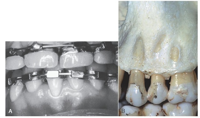 Influence of malalignment of teeth on form of gingival line and bone. A, Change in gingival line (free gingival margin) of central incisor. B, Absence of bone over root of tooth in labioversion (fenestration).
