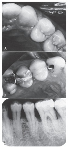Contact areas. A, "Contacts" without evidence of dysfunction. B, "Restored" contact areas associated with dysfunction from food impaction. C, Loss of contacts associated with bone loss due to periodontal disease.