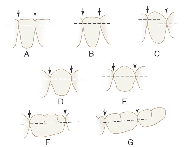 Contact levels found normally on mandibular teeth. Arrows point to embrasure spaces. A, Central and lateral incisors. B, Central and lateral incisors and canine. C, Lateral incisor, canine, and first premolar. D, Canine and first and second premolars. E, First and second premolars and first molar. F, Second premolar and first and second molars. G, First, second, and third molars.